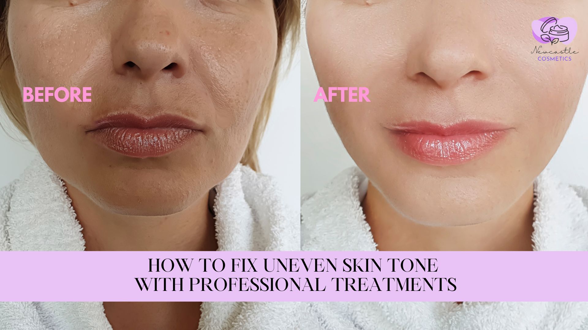 How to Fix Uneven Skin Tone with Professional Treatments